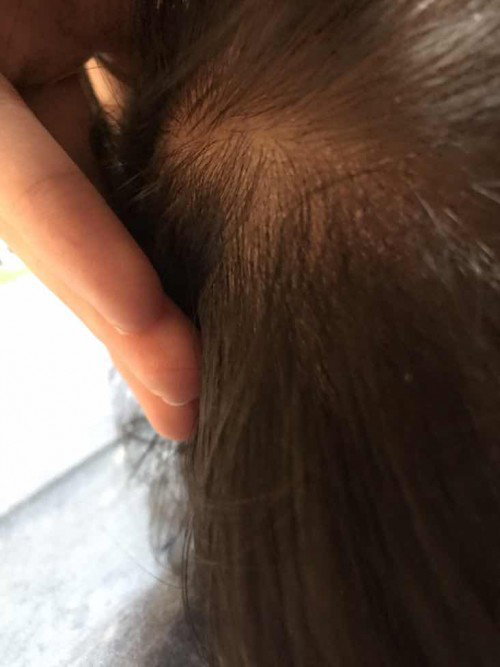 น้อง7 เดือน หัวลอกแบบนี้ทำไงดีคะ