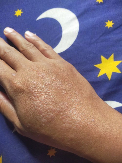 Gatal ga tertahankan