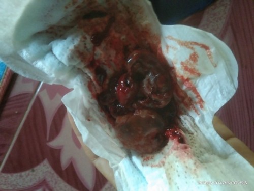 10สัปดาห์5วัน