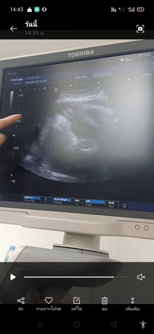 พึ่งไปซาวมาค่ะ ซาวดูรกกับน้ำคล่ำ เลยให้หมอดูเพศลูกให้ค่ะเพราะเราไม่ได้ฝากคลินิค แบบนี้ญ/ชคะ แม่ๆ