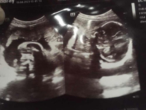 แม่ๆช่วยดูหน่อยค่ะ ว่าน้องเป็นผู้ชายหรือผู้หญิง 28+3w