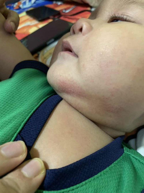 Cara hilangkan ruam baby