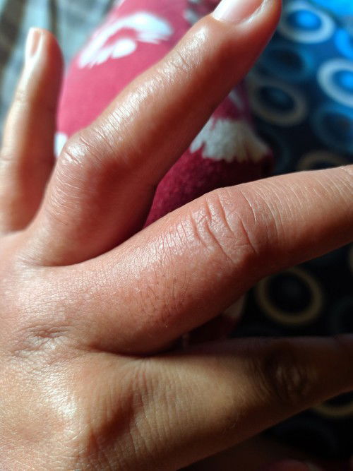 Jari tangan gatel bengkak, plus kutu air