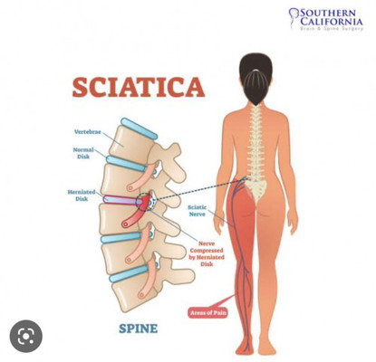 Sciatica @ 33 weeks