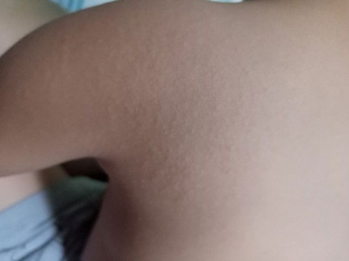 Hellow mga mommy sino same ko dito yung 4 years old kong anak  bigla namaga yung sa gilid ng tinga n