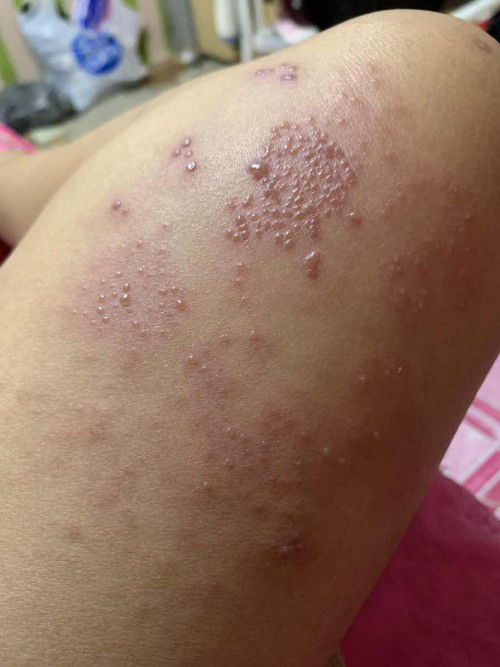 16weeks and 4days pregnancy rash