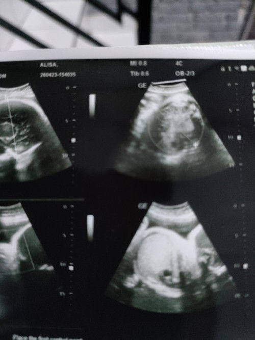 Ketuban keruh diusia kandungan 37-38week. Bagaimana cara mengatasi dan apakah bahaya?