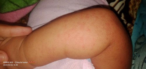 Solusi nya bun untuk biang keringat seperti ini.