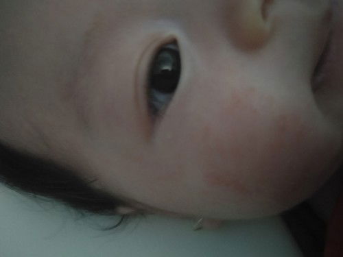 Bị chàm sữa phải không