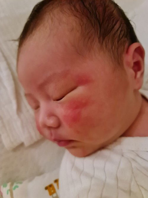 My baby is having red rashes on cheeks and head. Red and pops out with white dots. Is this OK?