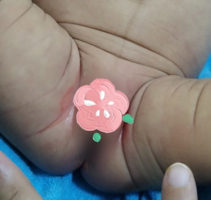 สอบถามอาการแพ้แพมเพิส