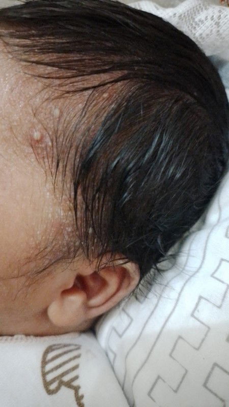 Sharing Bun , anak saya kepalanya penuh jerawat seperti difoto itu knapa ya Bun .ada yg sama ga?