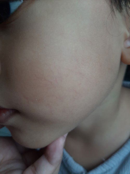 Spider vein/urat halus di wajah anak, apakah seiring waktu akan berkurang? Usia anak 3,7 tahun