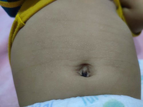 ลูกเป็นผื่นสีขาวปกติมั้ย