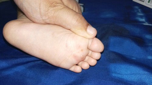 Gatal di telapak kaki