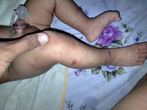 Gatal bintik merah pd bayi usia 2 bulan 18hari