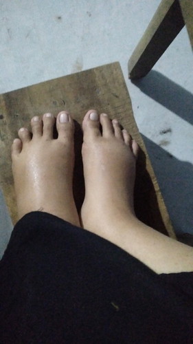 CARA MENGATASI KAKI BENGKAK SETELAH MELAHIRKAN GIMANA BUN? 🥺