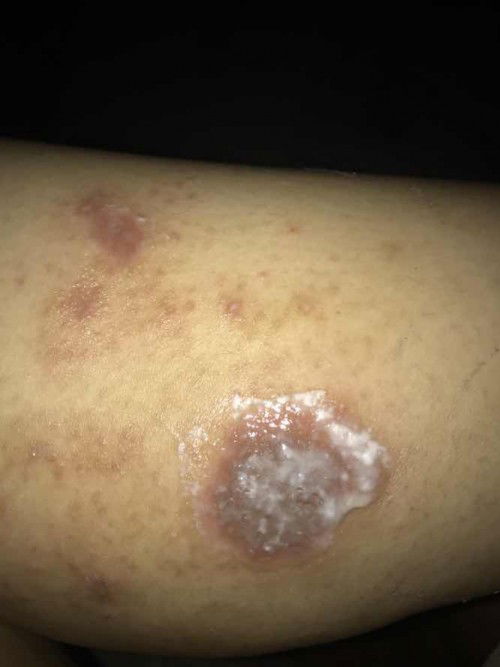 Gatau kurap atau eksim atau herpest