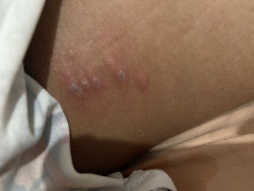 Shingles? 26wks FTM.