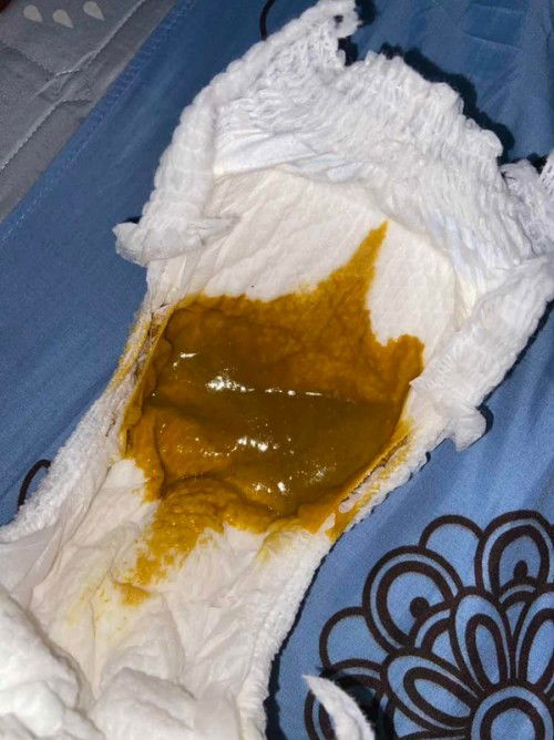 Poop bayi normal atau tidak?