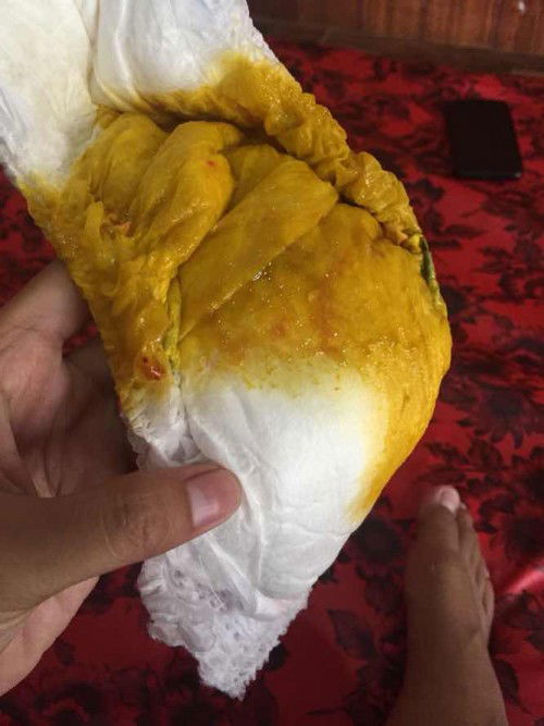 Bab berdarah pada bayi