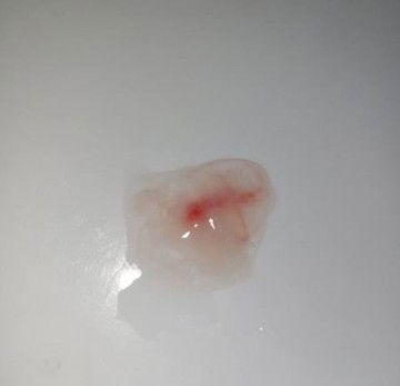 Keputihan yang bercampur dengan darah