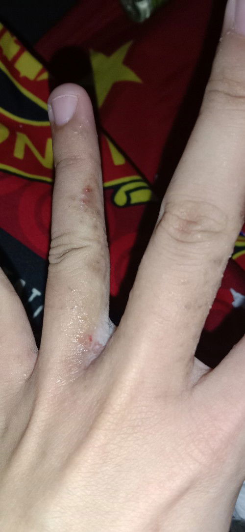 Bruntusan seperti cacar air