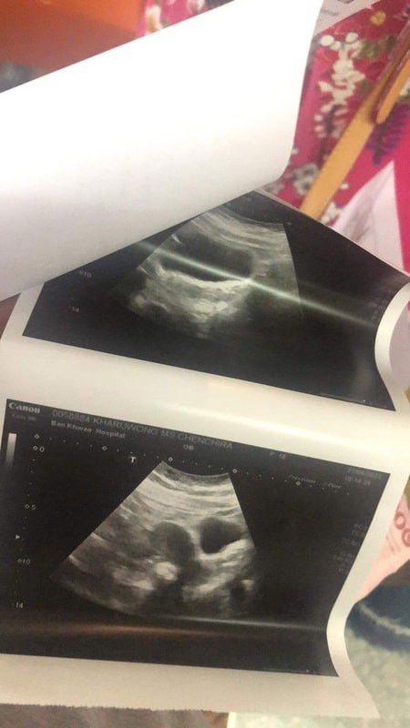 อัลตร้าซาวด์ไม่เจอ