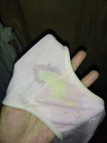 Discharge o Mucus Plug