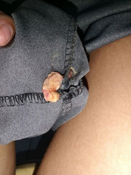 คือก้อนอะไรคะ