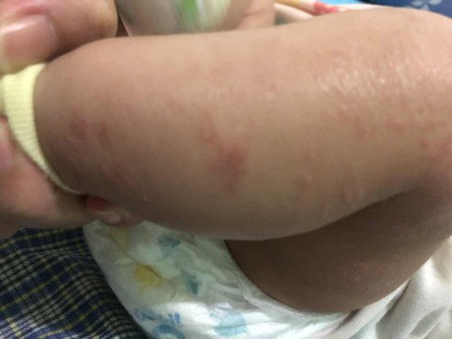 Alergi yg tak kunjungan sembuh pd baby usia 3bln