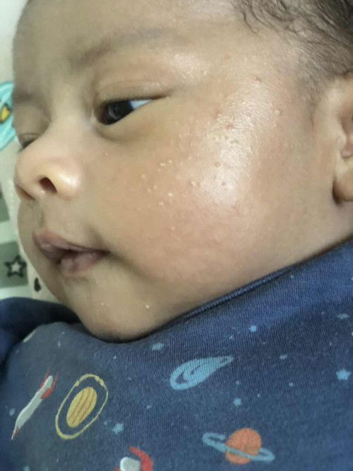 Bintik seperti bruntusan di muka bayi