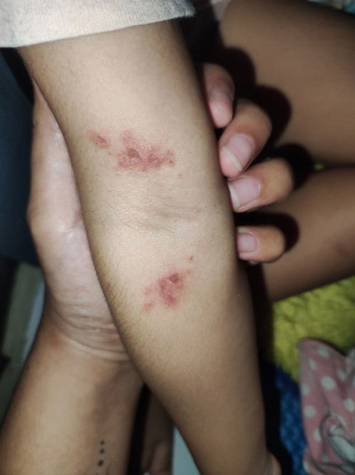 Muncul bercak merah ditangan