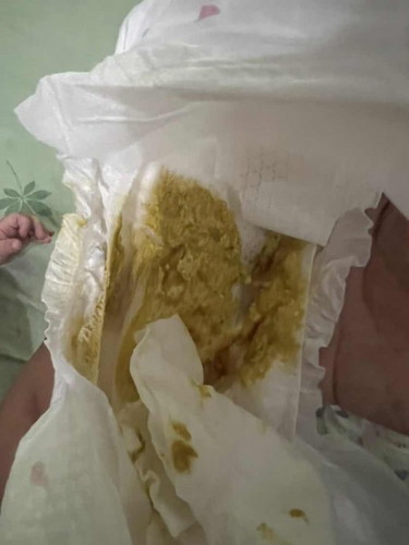 Bayi cirit birit lebih dari 10 kali sehari