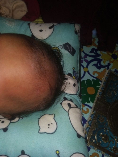 Rambut bayi rontok