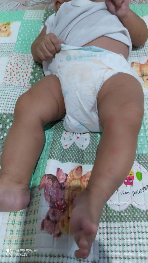 Bun mau tanya? Apakah bentuk kaki anak saya ini normal? Soalnya ada yg bilang bentuk kakinya O karen