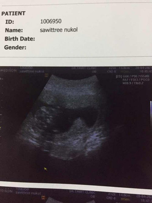 มดลูกรูปหัวใจ+เนื้องอกปากมดลูก