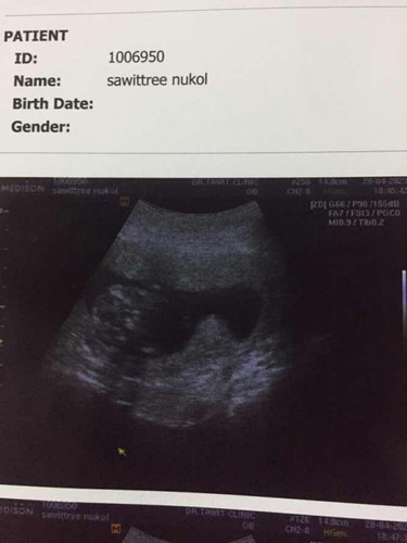 มดลูกรูปหัวใจ+เนื้องอกปากมดลูก