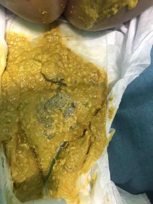 Najis bayi baru makan