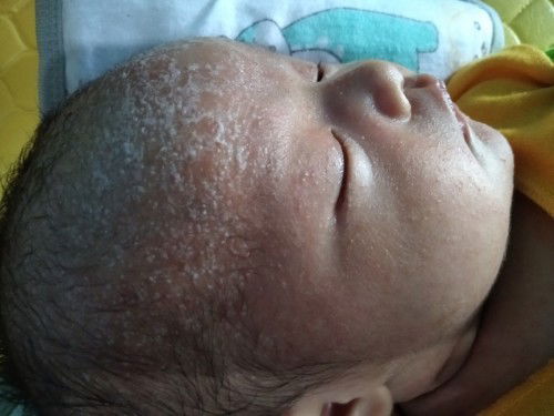 Bia keringat bintik merah