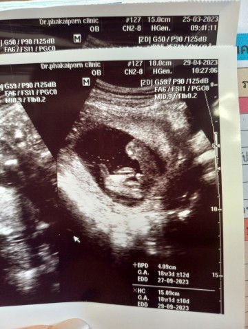 แม่ๆช่วยดูหน่อยค่ะ ผช100%? หรือมีโอกาสเป็น ญ รึเปล่า บ้านไหนมีประสบการณ์ผลซาวด์ไม่ตรงเพศลูกบ้างคะ