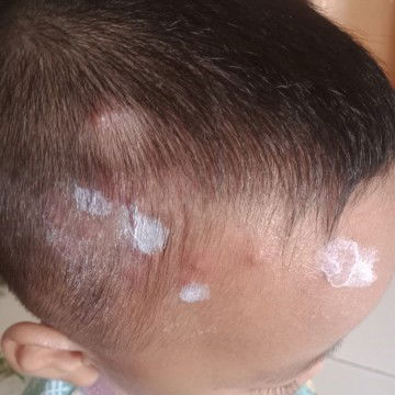 Obat "apoy" bentol merah atasnya ada nanah