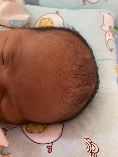 หน้าผากลูกมีตุ่มขึ้นเเบบนี้เป็นเพราะอะไรค่ะ มียาตัวไหนทาได้บ้าง เค้าเรียกว่าเป็นอะไรพอมีใครทราบไหมค่ะ