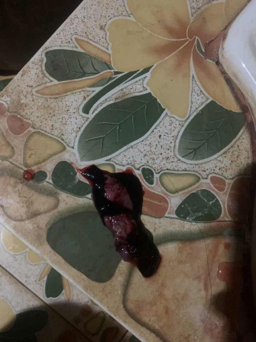 แบบนี้แท้งใช่ไหมค่ะ