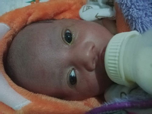 Mata bayi belekan sebelah