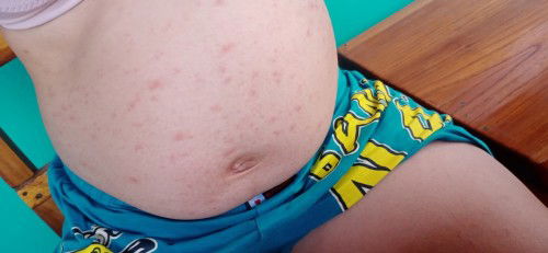 ผื่นขึ้นตามตัว