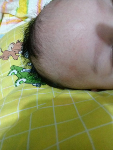 Bun ,anak saya 3 bulan. Dahi sama pipi nya bintik² gitu , kenapa ya? Ada yg sama kayak anak sya gak?
