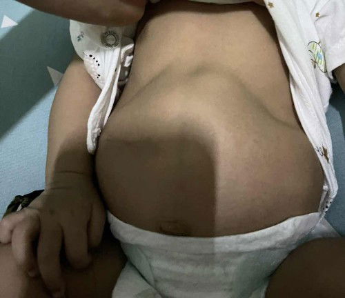 Viêm phổi ở trẻ sơ sinh