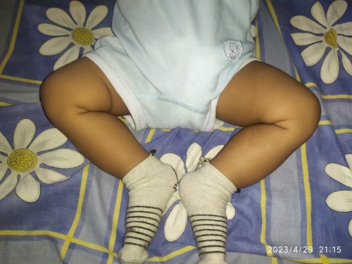Ada yang sama enggak bun lipatan paha anak saya berbeda, usia saat ini 4 bulan