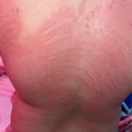 Dermatographia